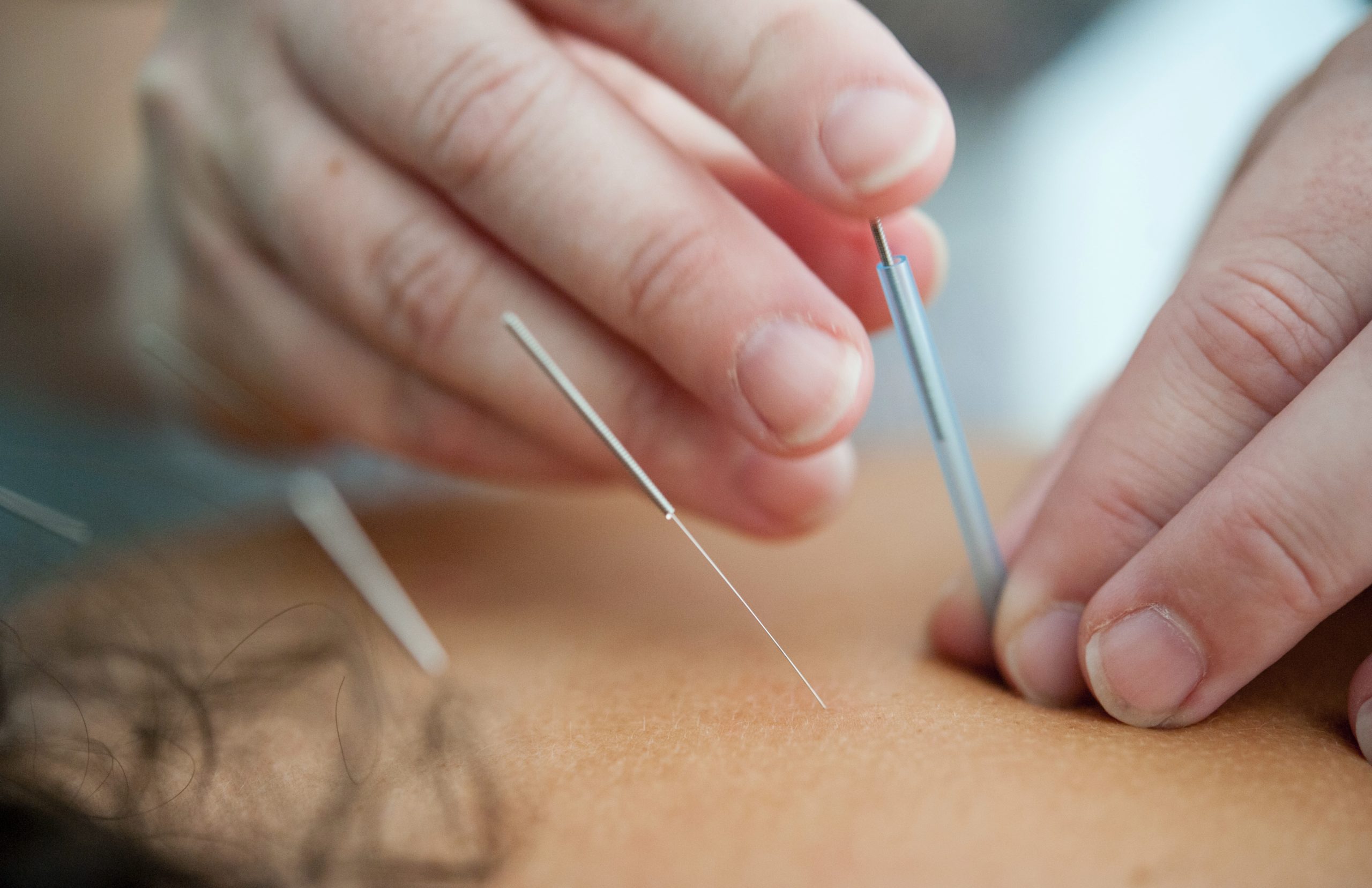 Close-up of an acupuncture needle being placed by a practitioner